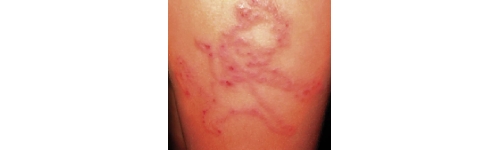 Eczema e dermatiti